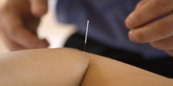 Akupunkturbehandling